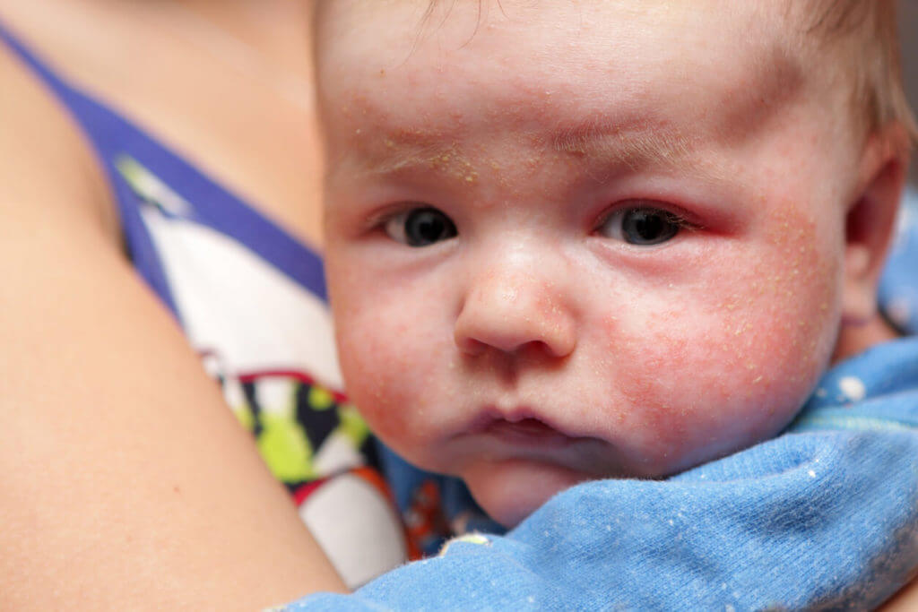 face of a newborn with eczema
