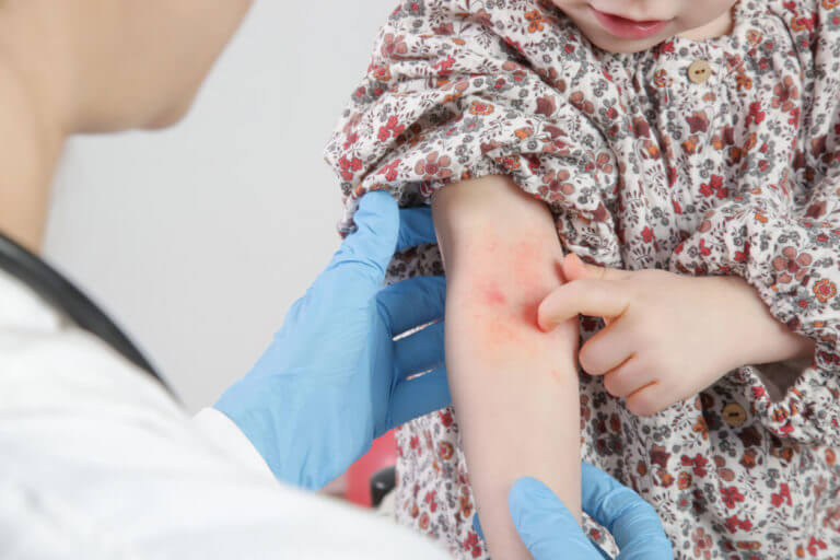 Atopic Dermatitis Treatment in Pheonix