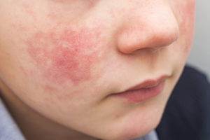 Eczema on the Face - Treatment in Phoenix