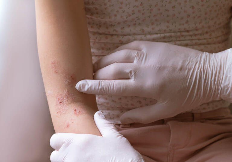 Doctor´s hand in medical gloves examining skin eczema on a child´s right arm