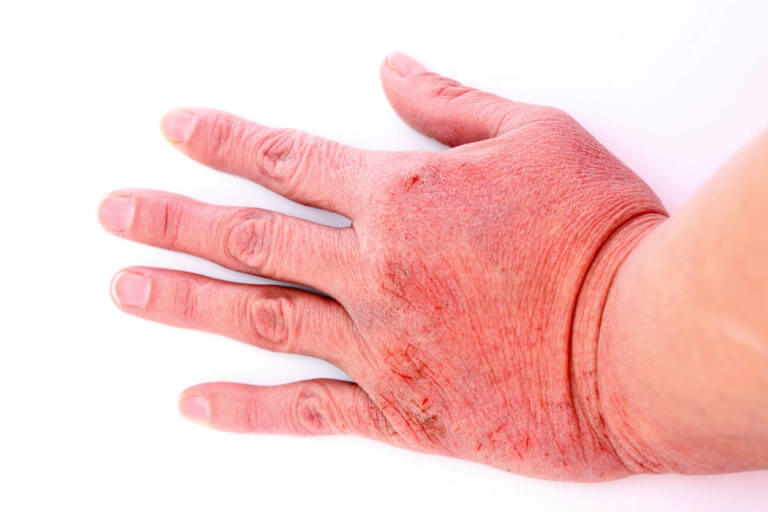 Image of a person with Hand Dermatitis.