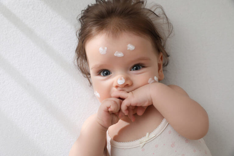 Infant with eczema treatment cream on her face.